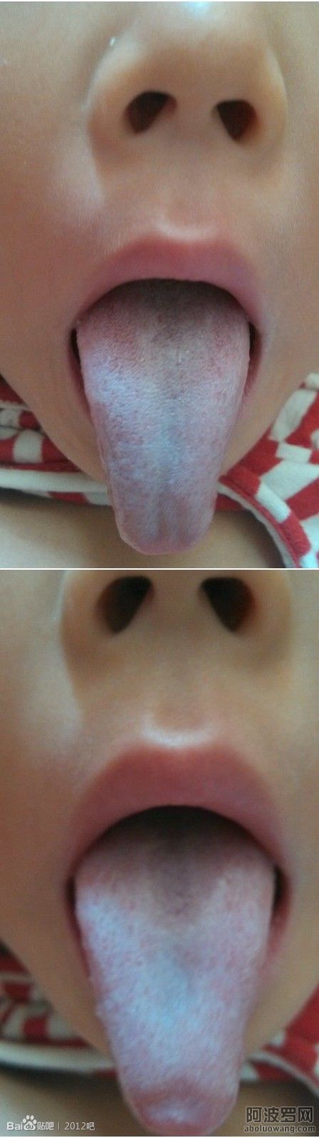 症状孩子舌苔_2.jpg