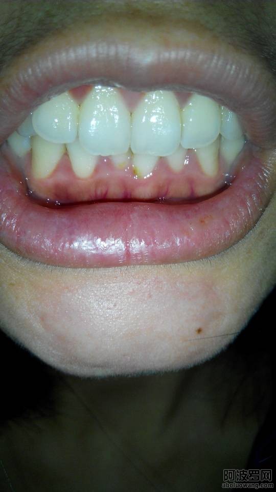 症状牙龈_1.jpg